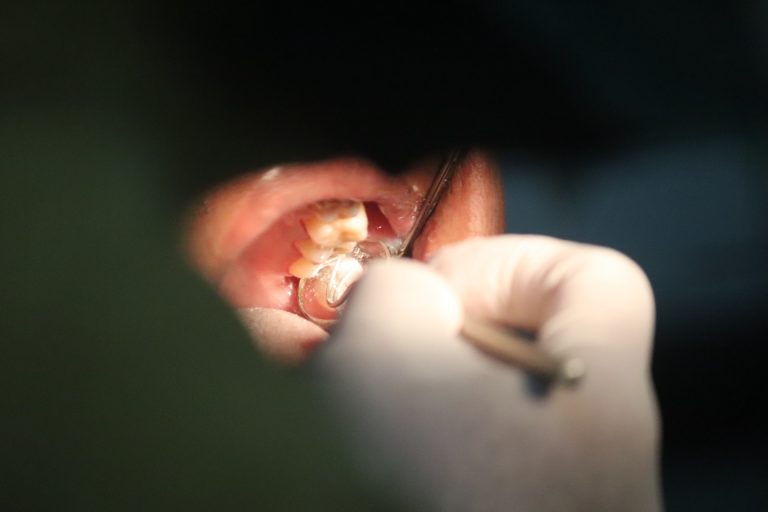 Zahnstein – woher kommt er, und wie wird er entfernt?