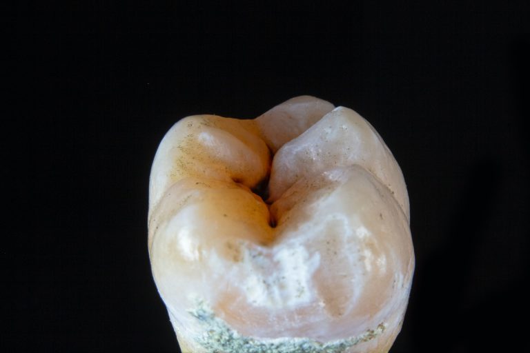 Krank durch Zähne: Symptome im Körper erkennen