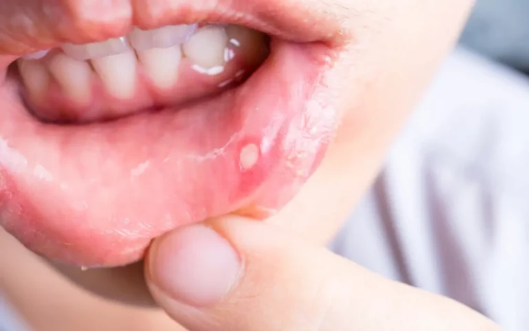 Aphthen & Bläschen im Mund: Ursache & Behandlung