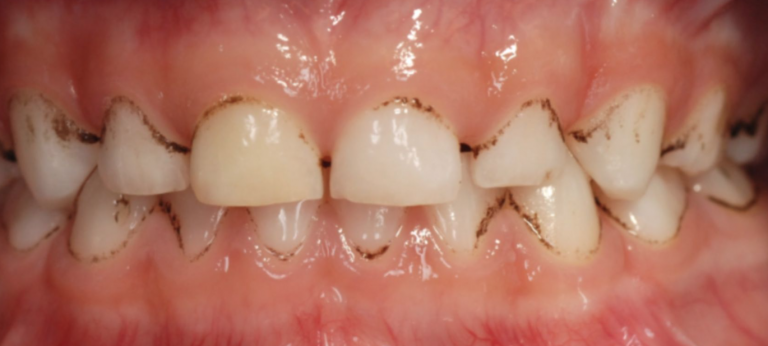 Black Stain – schwarze Zahnverfärbung: Ursachen & Behandlung