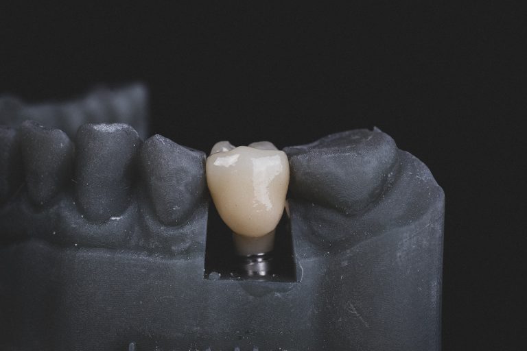 Risiken fehlender Zähne + 10 Gründe für Zahnersatz