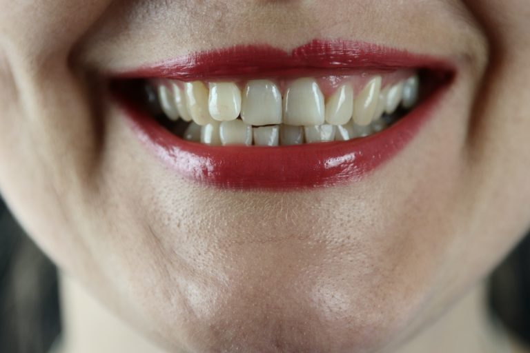 Warum wachsen Zähne schief? Ursachen und Prävention