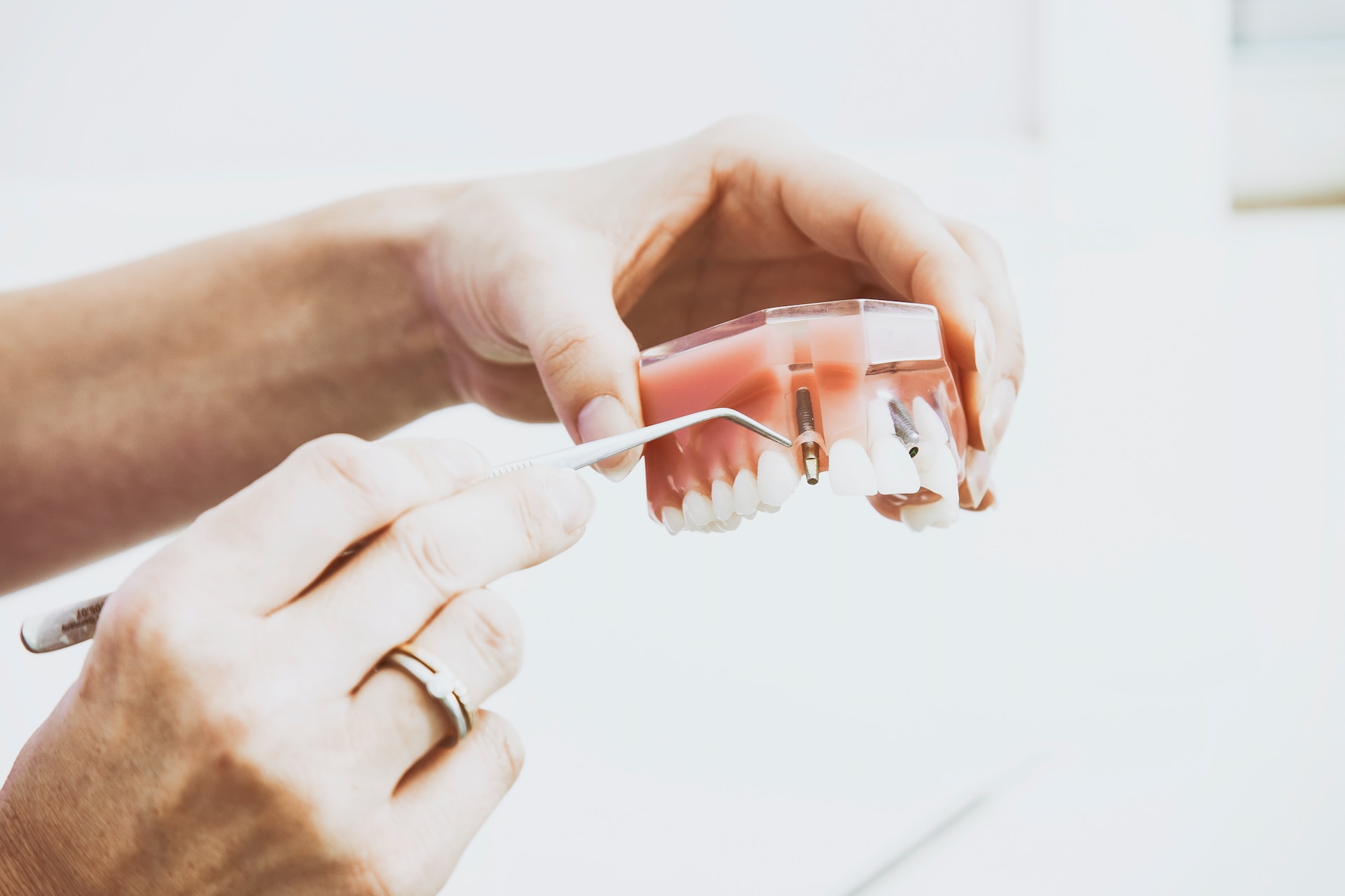 Wie Sie Ihr Zahnimplantat korrekt pflegen
