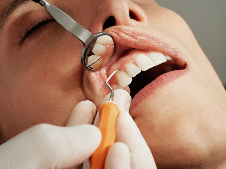 Was tun, wenn Zähne wackeln? - Ursachen und Behandlung