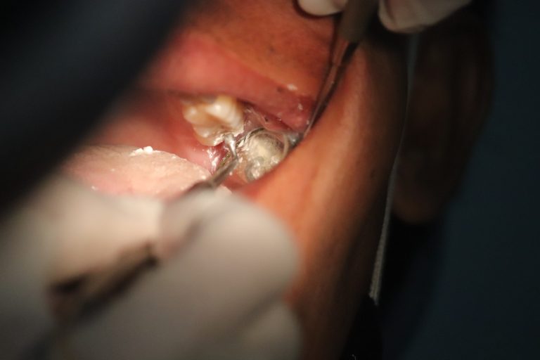 Zahnzwischenraum Karies - Symptome, Tipps und Behandlung