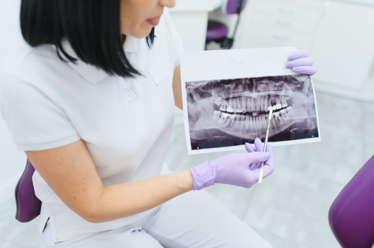 Retinierte Zähne – wenn Zähne sich im Kiefer verstecken