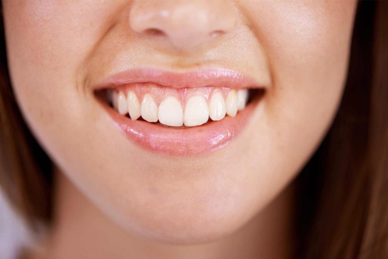 Freiliegende Zahnhälse: Ursachen, Vorbeugung und Behandlung