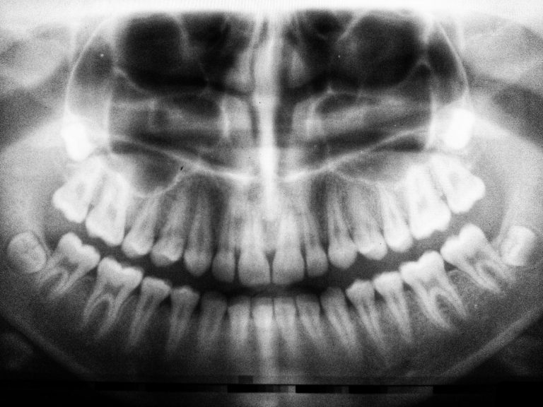 Wurzelresorption - Lohnt der Erhalt des Zahns?