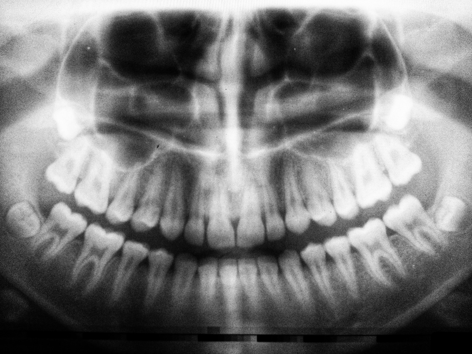 Wurzelresorption - Lohnt der Erhalt des Zahns?
